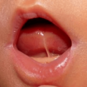 Anquiloglosia y Lactancia Materna